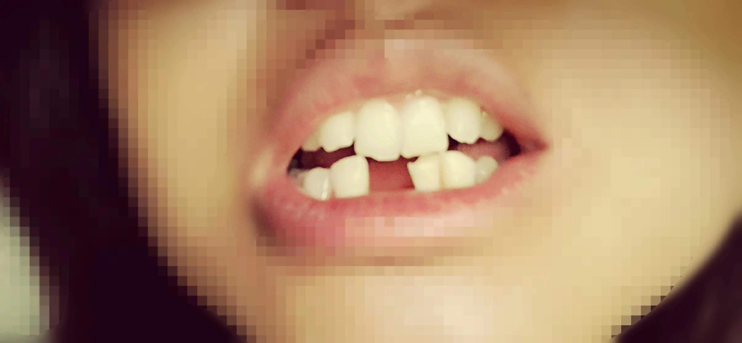 有没有种牙的经历,种牙经历及感受