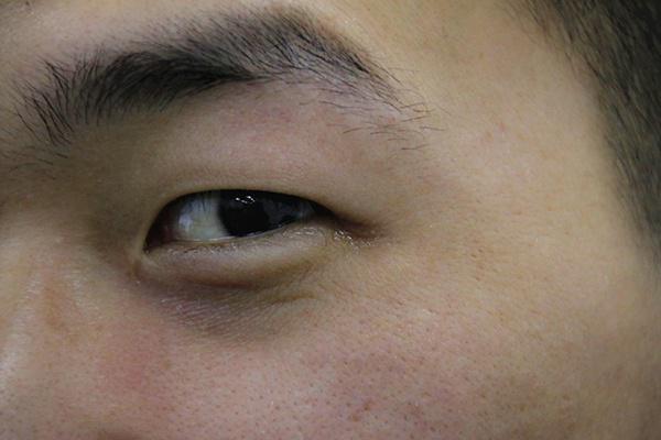 眼袋做完了眼部皮肤会不会松弛,眼袋松是什么原因导致的