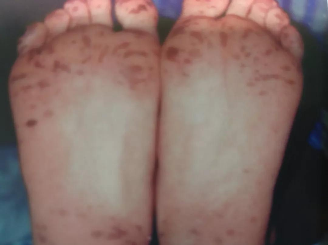 母亲嘴唇有黑斑遗传给孩子的概率,小孩嘴唇黑有什么病