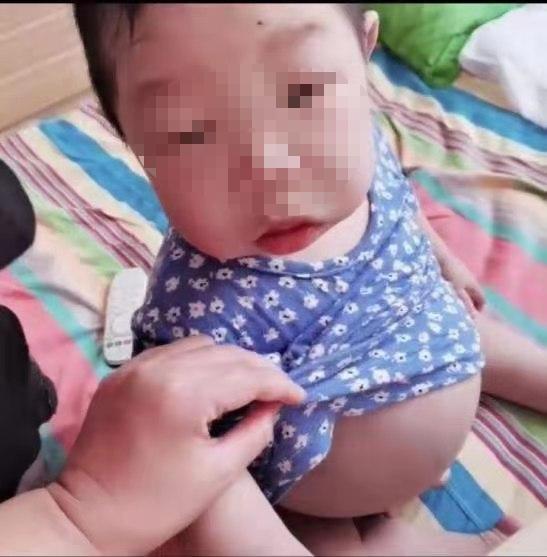 男童患怪病肚子大如瓜四肢如柴,男孩患罕见病肚子大