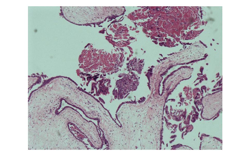 极为罕见！怀了双胞胎，却有一个是葡萄胎？高龄宝妈葡萄胎16周成功引产于阴道分娩