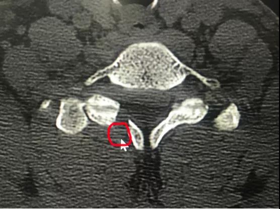 *安泰**市中心医院成功开展颈椎后路内镜“钥匙孔”技术治疗高度游离的颈椎间盘突出症