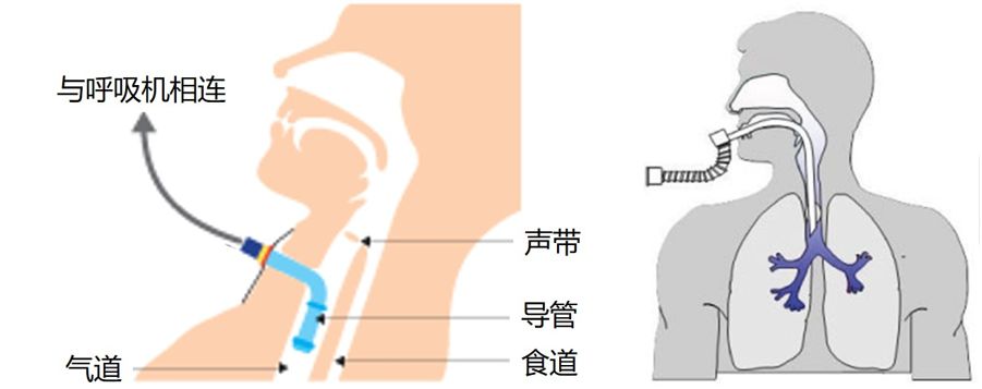 感染病毒,死于窒息:肺里究竟发生了什么?