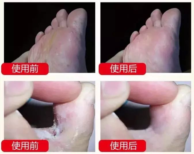 冬天脚跟干裂又起皮怎么办,冬天脚跟干裂起硬皮擦什么保湿好