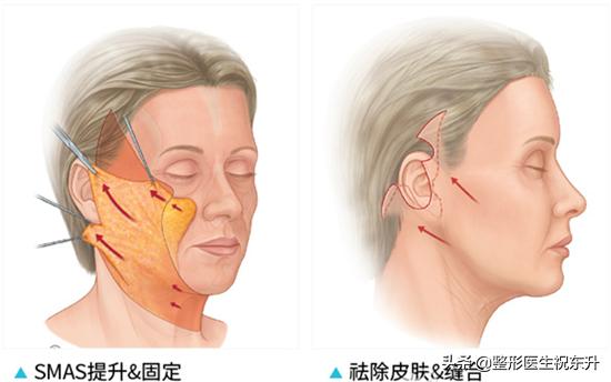 做小拉皮手术多久能恢复,做拉皮手术十年以后会变成什么