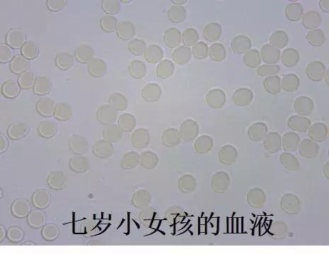 血液粘稠的病因及治疗,健康血液粘稠别小看但也别乱治