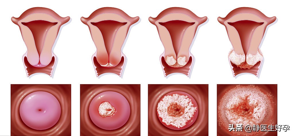 轻度宫颈糜烂对备孕有影响吗,静医生备孕有人成功吗