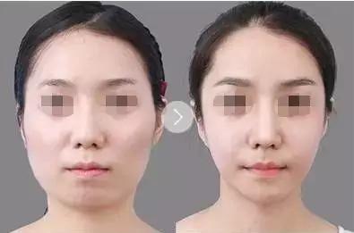 瘦脸针怎么避开腮腺,瘦脸针僵硬感怎么解决