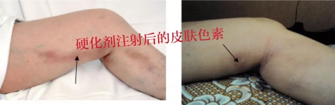 恐飞治疗视频,恐飞症能治好吗