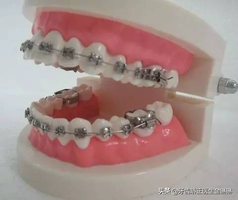 30岁牙齿牙缝大矫正一般多少钱,牙缝大牙齿松了怎么办