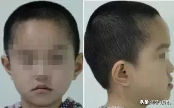 狗狗乳牙地包天怎么办,儿童乳牙地包天怎么办