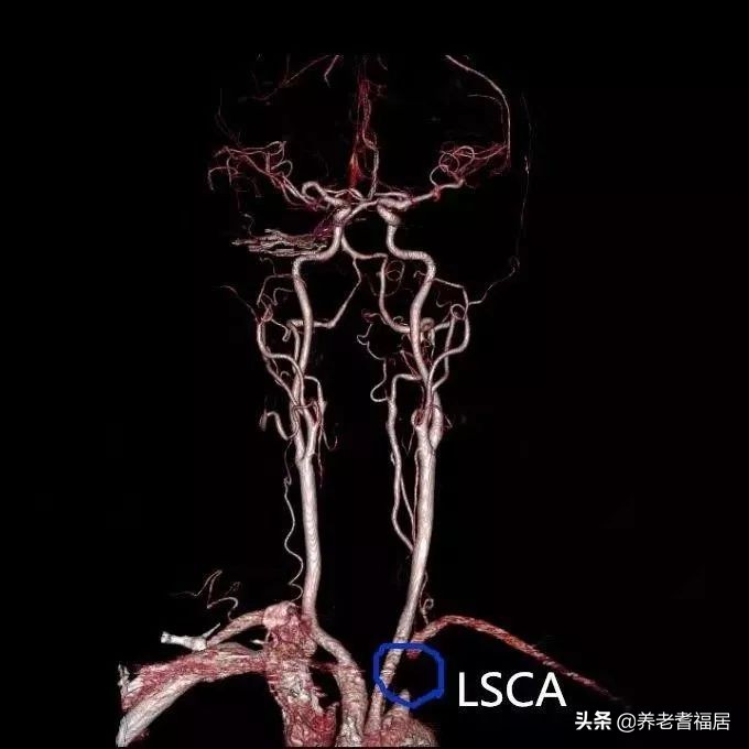 左右臂血压差别大要提高警惕,两个胳膊量血压数值差距大