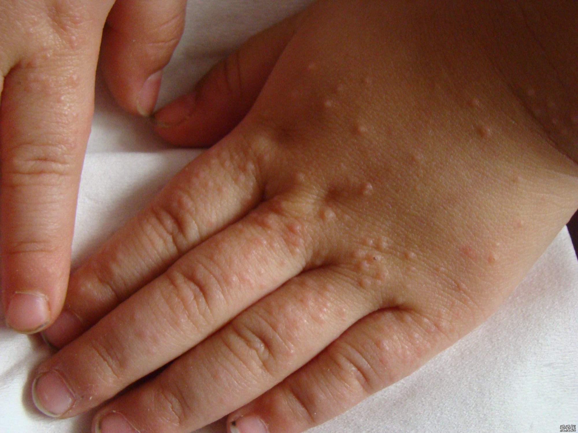 孩子常年身上痒湿疹怎么从内调理,儿科医生教你湿疹的正确护理方法