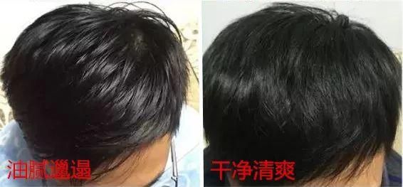 去头屑去螨虫哪个洗发水最有效,去头屑去螨虫用哪个洗发水最有效