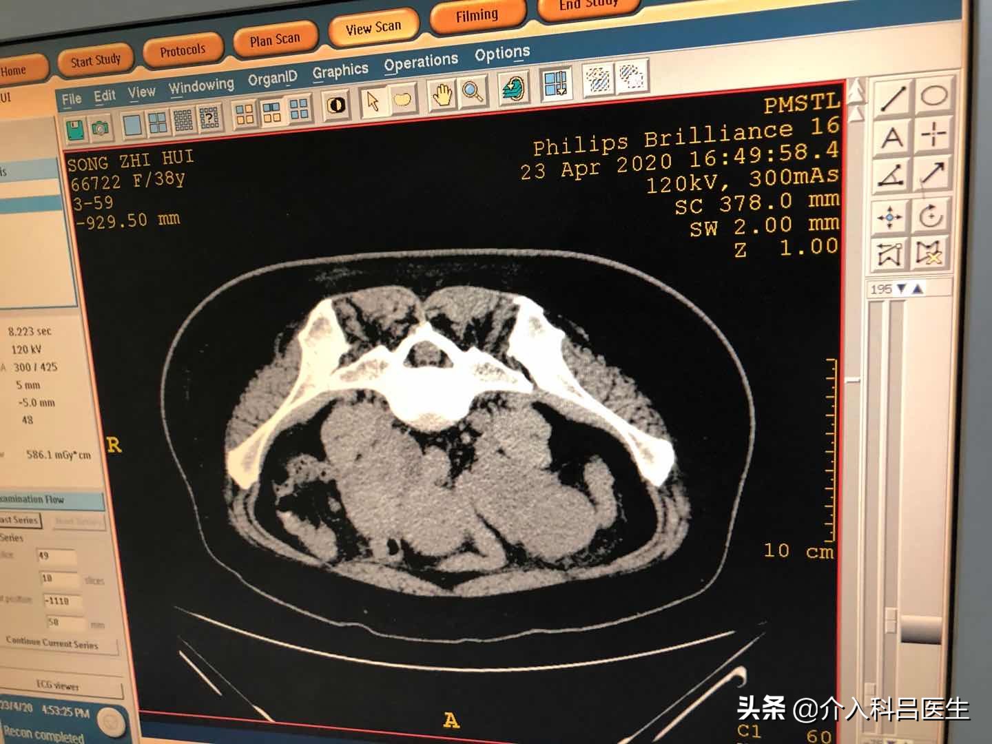 子宫腺肌瘤扎针效果好不好,子宫腺肌症巧囊手术