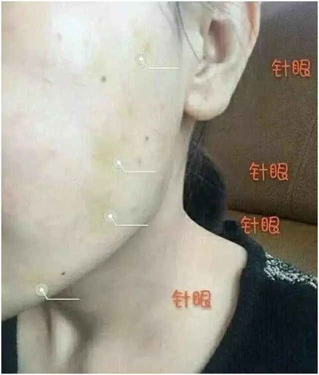 抗衰线雕面部提升多久做一次,无针线雕局部抗衰