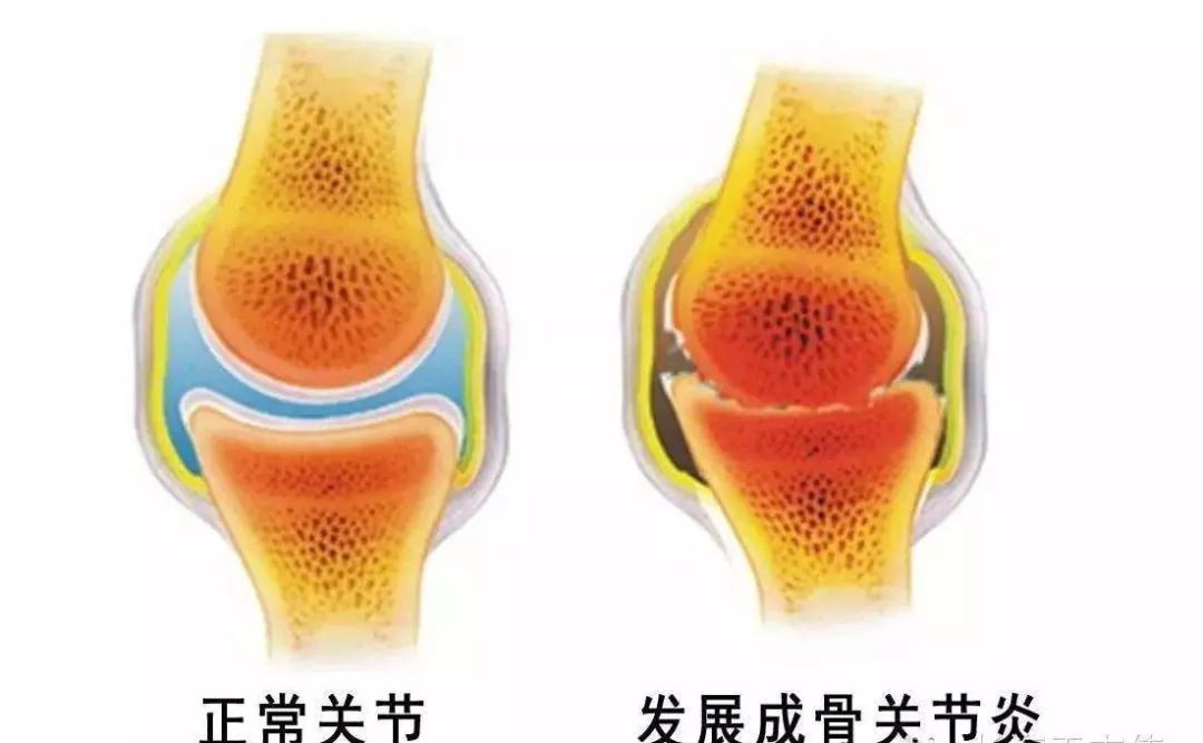 走路经常打软脚是怎么回事,走路猛然腿一软怎么回事