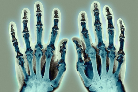 什么气候适合类风湿关节炎患者,类风湿夏天注意什么