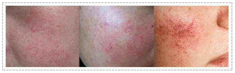 毛孔粗大最好的方法目前最有效的,毛孔粗大怎么缩小自然方法