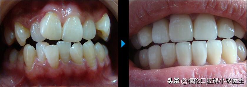 牙齿拥挤不拔牙能不能矫正,牙齿拥挤矫正3d视频