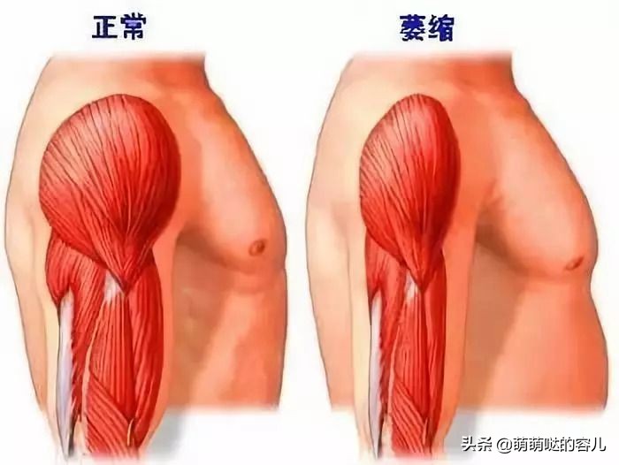 轻微肌肉萎缩症能治愈吗,肌萎缩是什么病能治疗吗