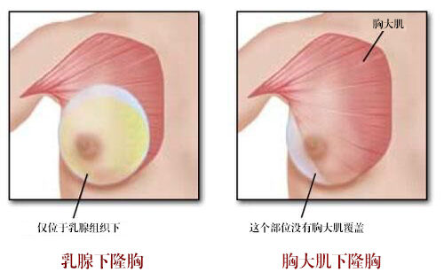 关于假体丰胸的问题,假体隆胸的5个问题