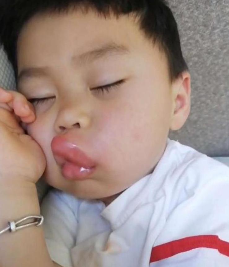 小孩嘴巴肿了一块,孩子一大早嘴巴肿了