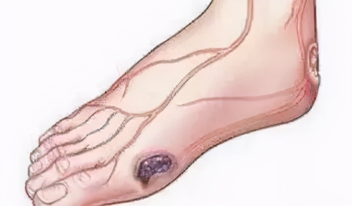 脊髓电刺激术治疗顽固性疼痛,脊髓电刺激术可以恢复运动功能嘛