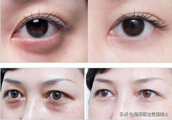 不要做眼袋手术的原因,千万不要去美容医院割眼袋