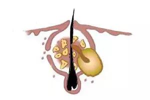 小学学生鼻子长黑头如何快速去除,怎样去除鼻子上的螨虫和黑头