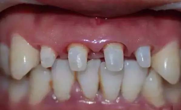 烤瓷牙的危害与副作用,全烤瓷牙有什么风险和后遗症