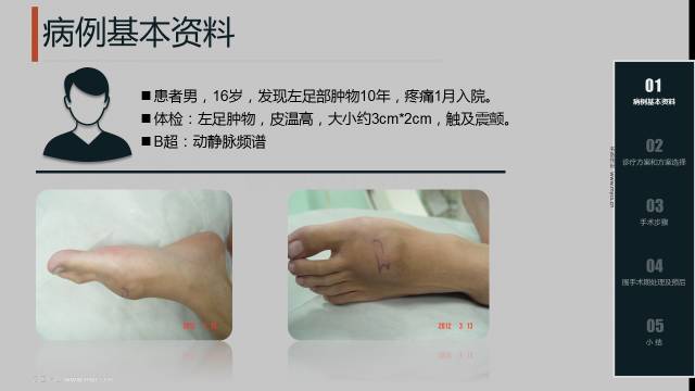 左侧颞窝动静脉畸形介入栓塞术,动静脉畸形介入栓塞后偏瘫