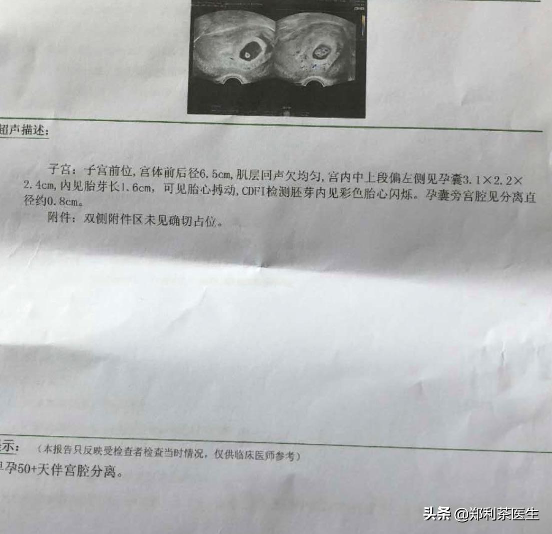 连续宫角妊娠,异位妊娠