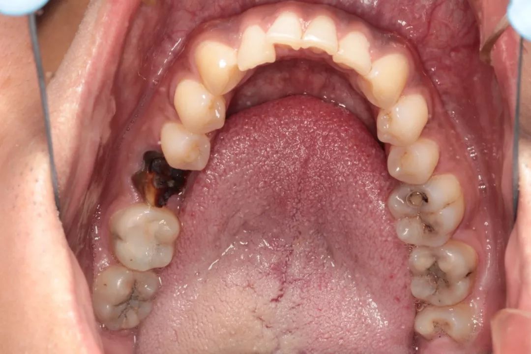 小“李敏镐”来咿呀口腔种牙了！