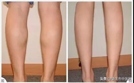 除了肉毒素还有什么能去皱,肉毒素去皱适合年龄