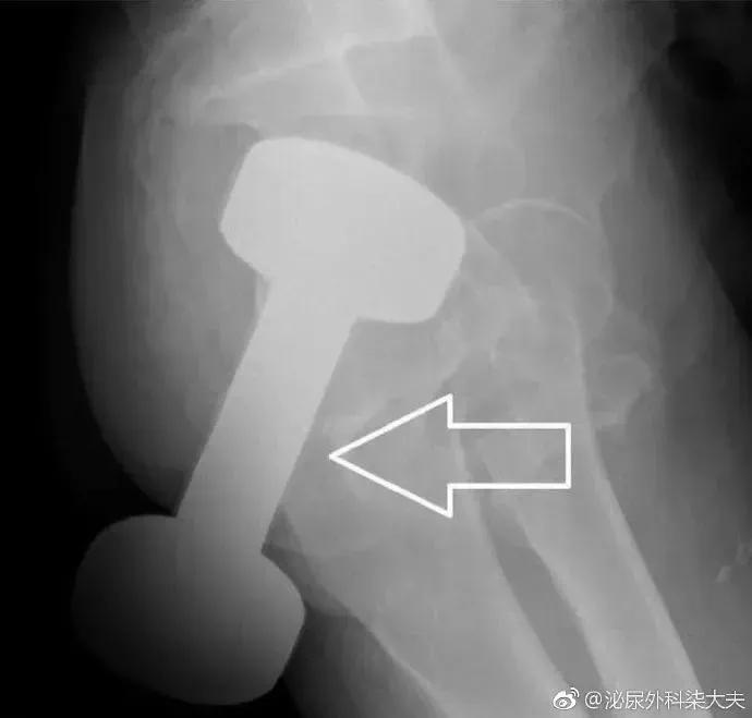 科普直肠息肉,直肠生理弯曲