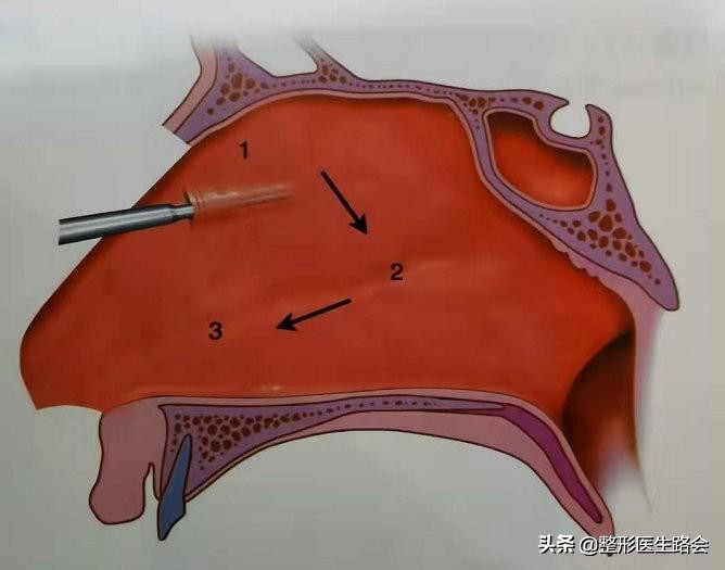 想去隆鼻,隆鼻到底值不值得入手