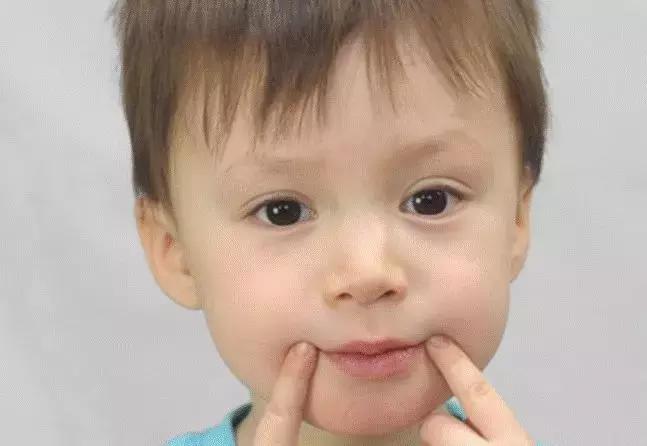 八个月宝宝烂嘴角最快治疗方法,宝宝烂嘴角是什么原因该怎么治