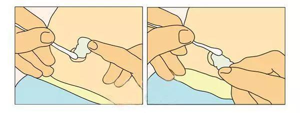 宝宝脐带化脓出血，迟迟不掉？引起感染触及诸多并发症不容小觑