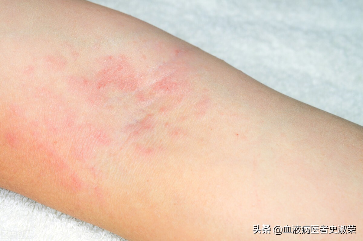 单纯的过敏性紫癜治愈会不会复发,单纯皮肤过敏性紫癜会发展到肾吗