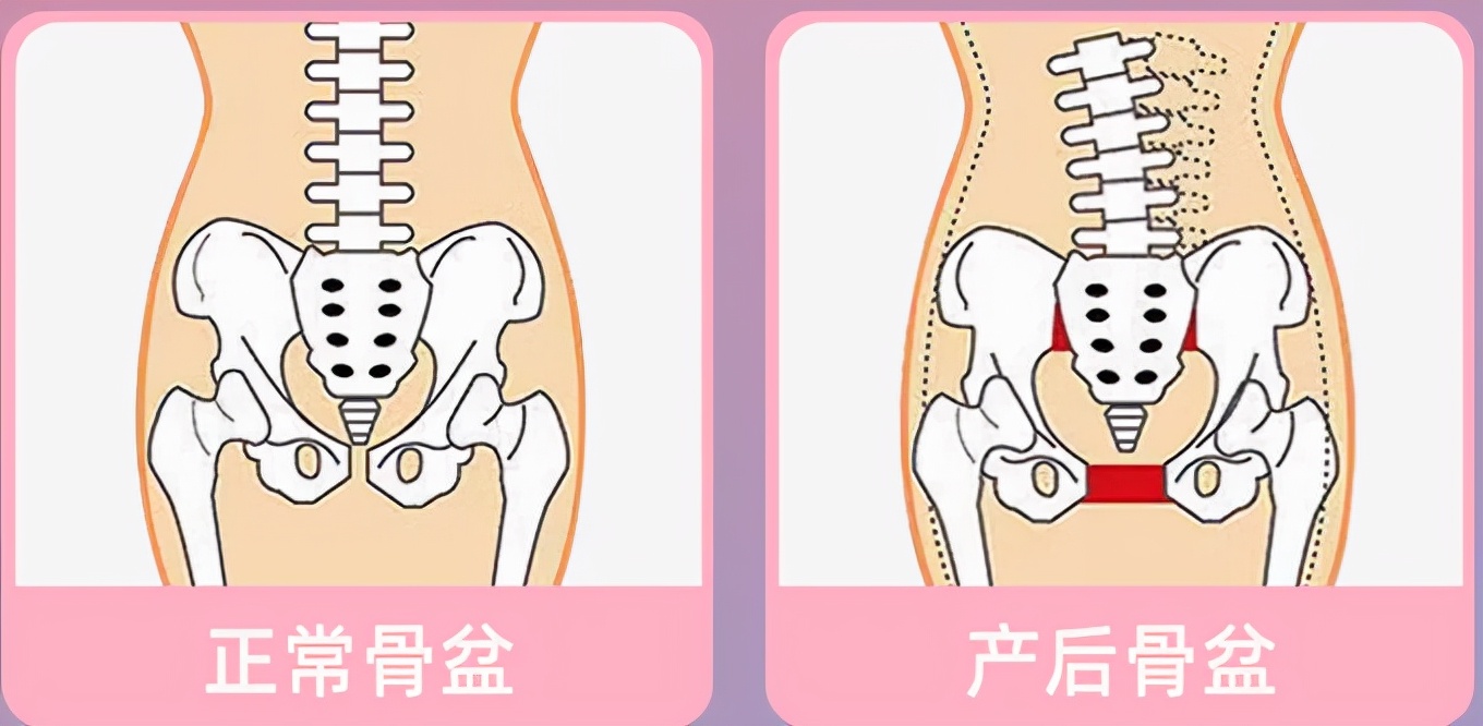 产后一年错过修复黄金时期，做盆底肌修复还有用吗？