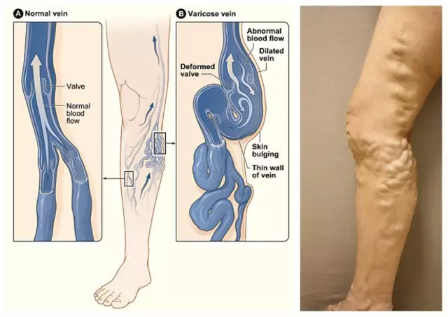 教师下肢静脉曲张的概率,下肢静脉曲张的高危人群及科室