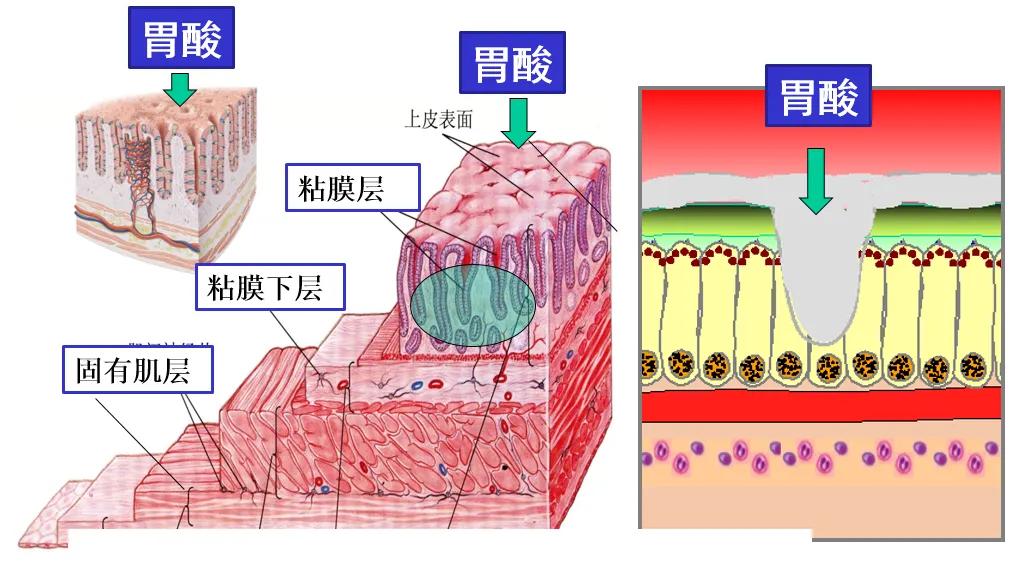 肠上皮化生是癌症吗,肠上皮化生什么意思