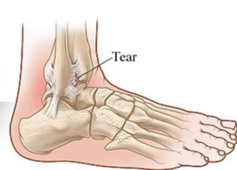 崴脚了要怎么自救,脚崴了一个月了该怎么办