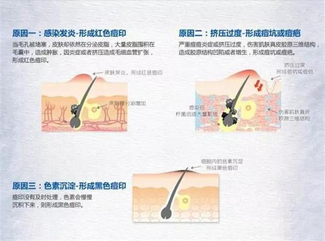 为什么痘印祛不了,为什么痘印去除不了