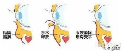 关晓彤怎样去泪沟,关晓彤眼袋去除视频