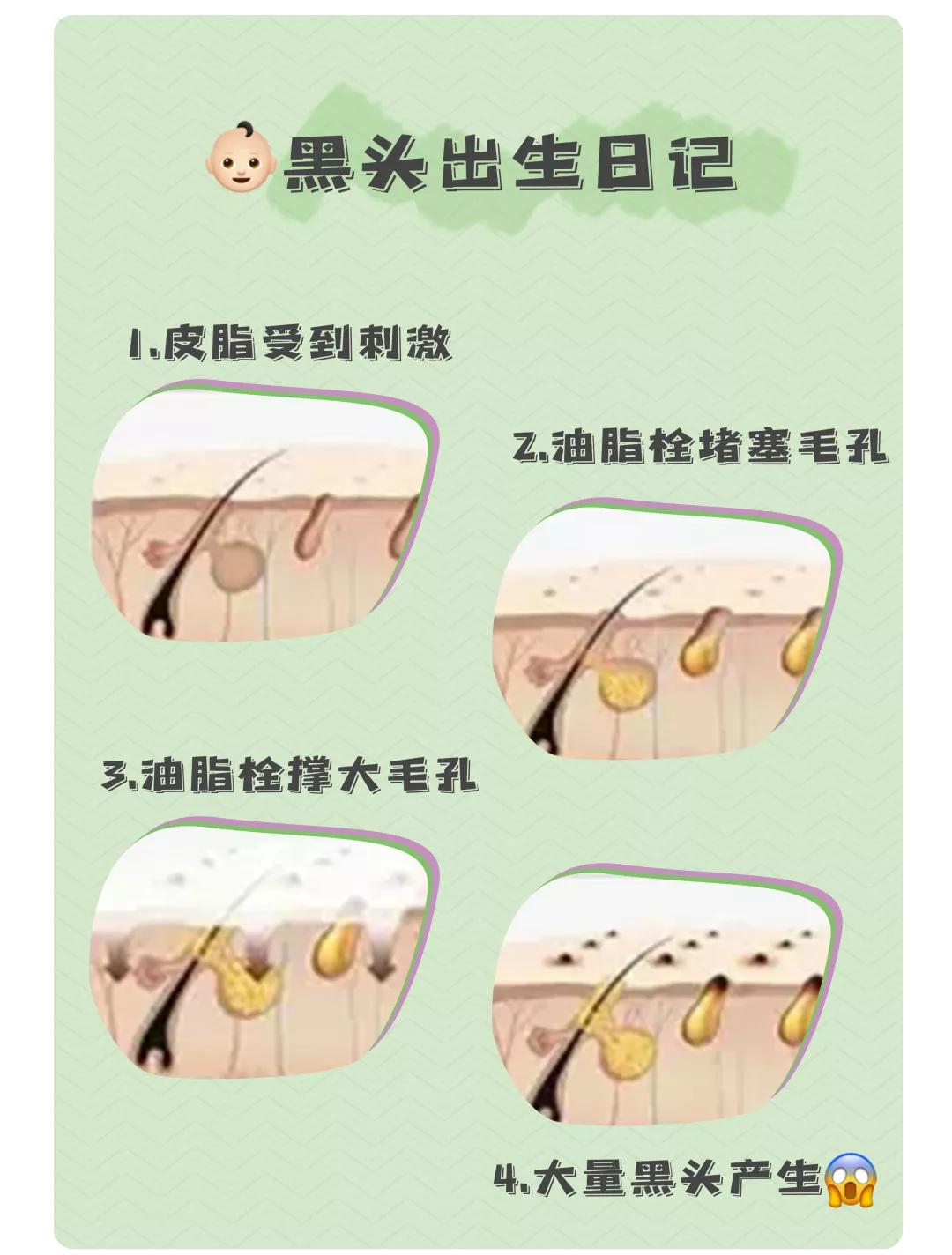 去黑头最好的方法不会再有黑头,如何用简单的方法去黑头真实有效