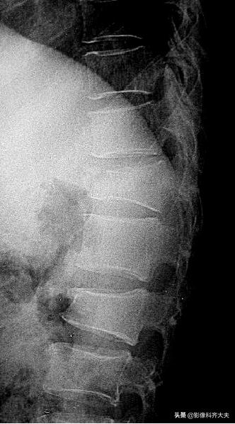 骨折的影像学检查及各自的优势,骨折的影像学愈合标准