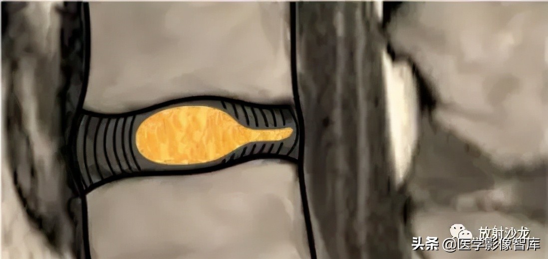 一键收藏所有的内容,颈椎间盘病变的症状和治疗