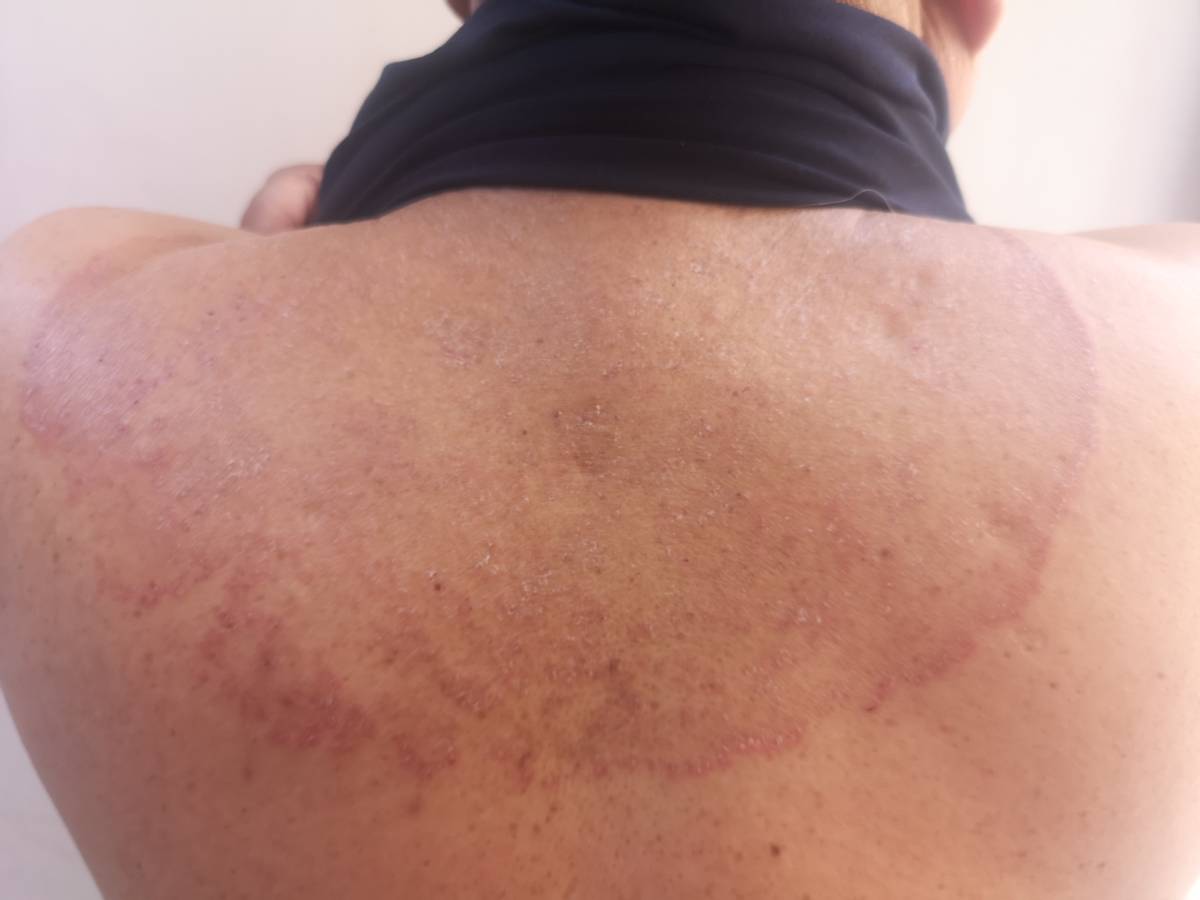 远离真菌,验方治愈一切真菌感染皮肤病